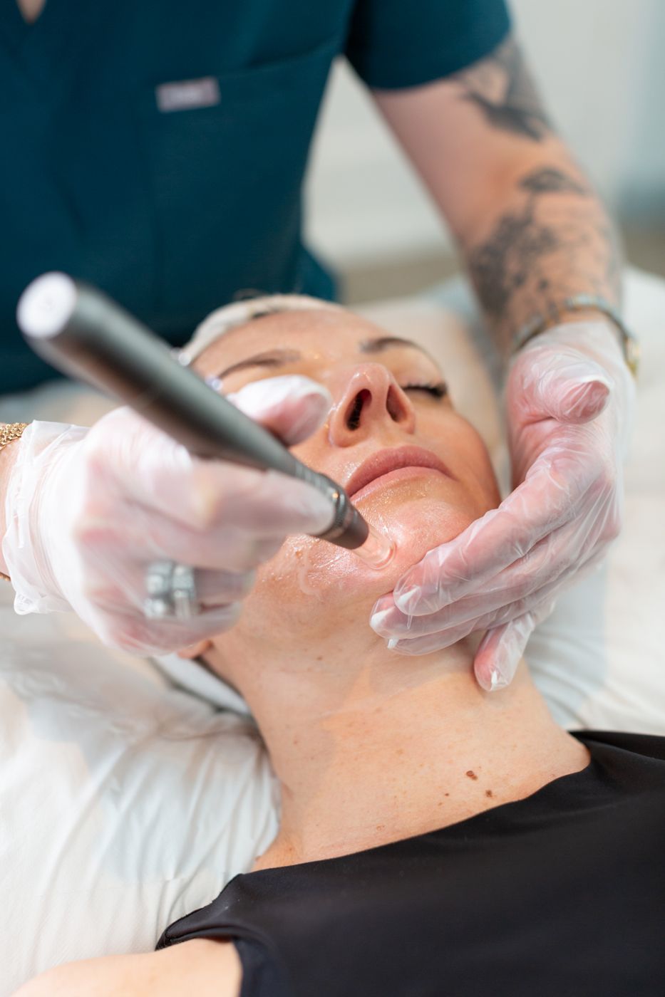 Microneedling at Idunn Rejuvenation, Cobham